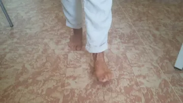 Vbočený palec - chôdza