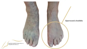 halux po operácii
