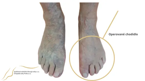 halux po operácii