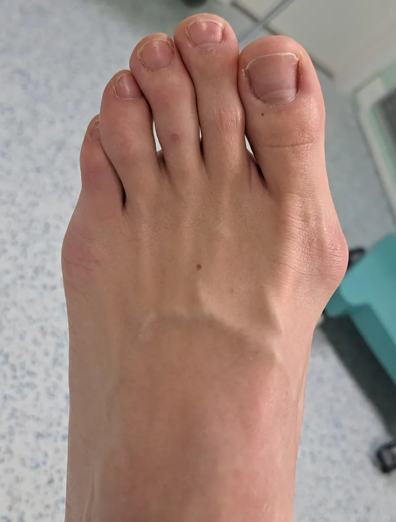 Mini invazívna korekcia vbočeného palca - pred operáciou