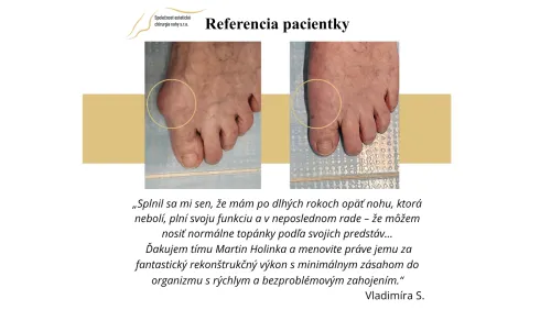 Referencie pacientov Estetickej chirurgie nohy