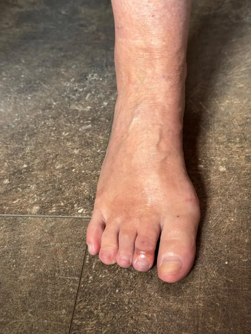 Výsledok operácie deformity prstov