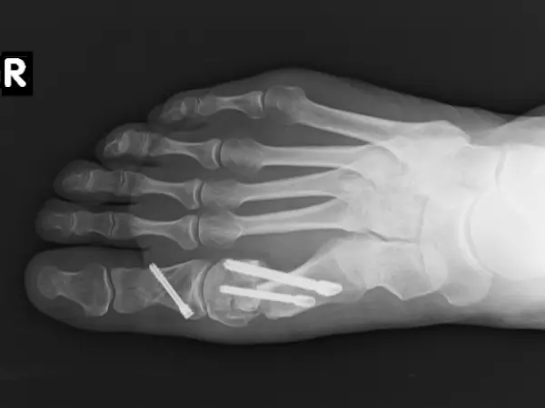 Vbočený palec - Röntgenový snímok šesť týždňov po operácii
