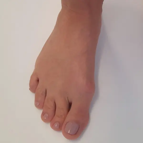 Miniinvazívne riešenie artrózy palca - predoperačné foto