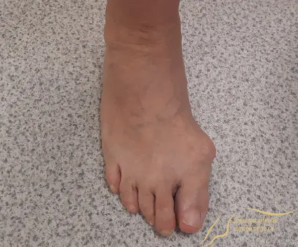 Vbočený palec na pravej nohe.