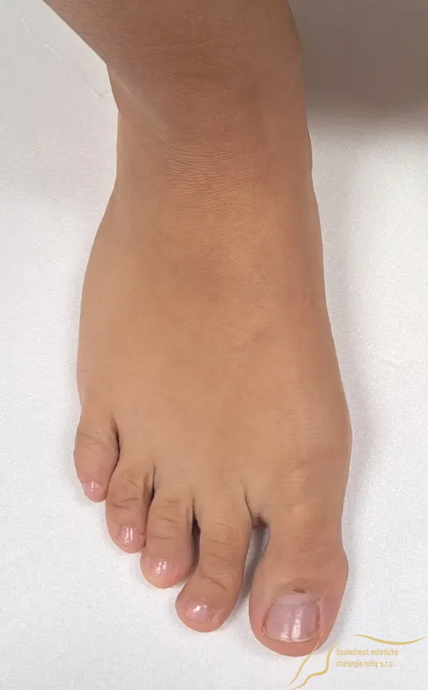 Predoperačná fotka deformity 2. prsta nohy