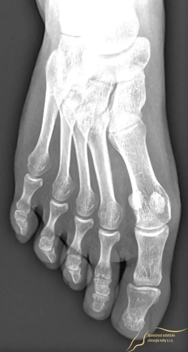 Pooperačný röntgenový snímok 5 mesiacov po operácii