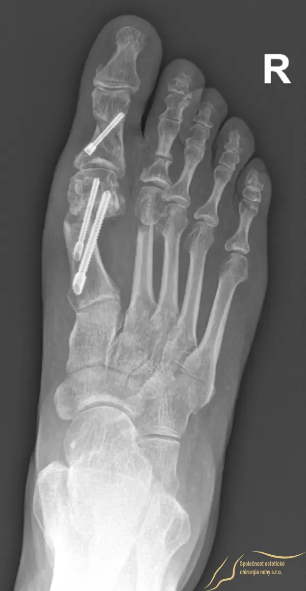 Pooperačná röntgenová snímka