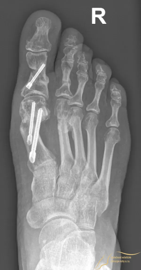 Pooperačný röntgenový snímok po zahojení kostí